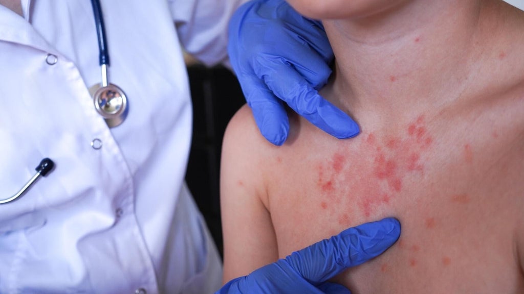 Minnesota's 80 measles cases this year are the most since 1990, health officials say — Fridley Health news