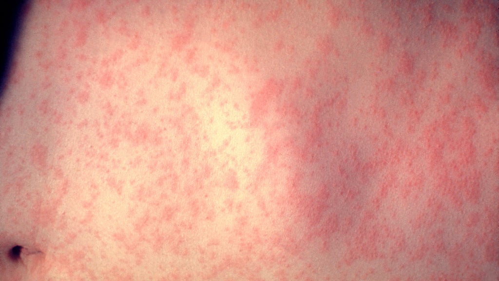 25 cases of measles identified in central, southeastern Minnesota, MDH says — WCCO / CBS Minnesota, Fridley Health news