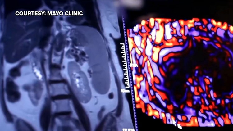 Healthy SA: Battling liver cancer, a disease which often has no symptoms early on — KENS 5 (San Antonio), Fridley Health news